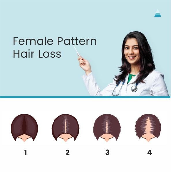 Female Pattern Hair Loss