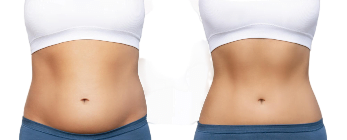 Does CoolSculpting work for Abdomen