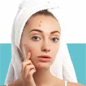 acne to clear skin