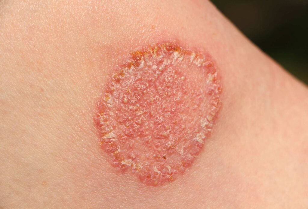 Fungal Infections: Types, Causes and Solutions