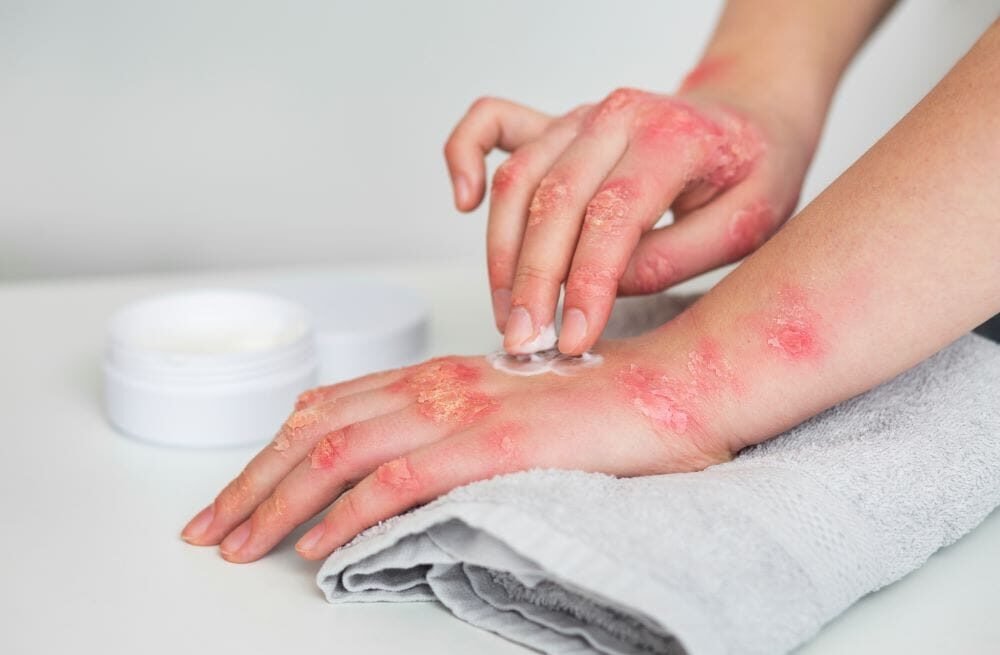 Exploring Psoriasis: What It Is and What Causes It