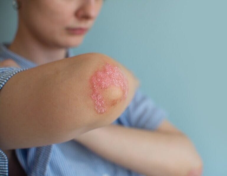 Psoriasis: Types and Treatment Options