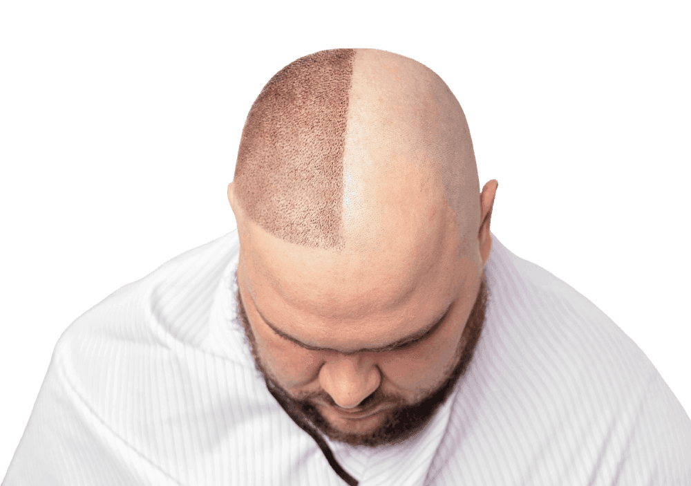 Scalp Micropigmentation 1