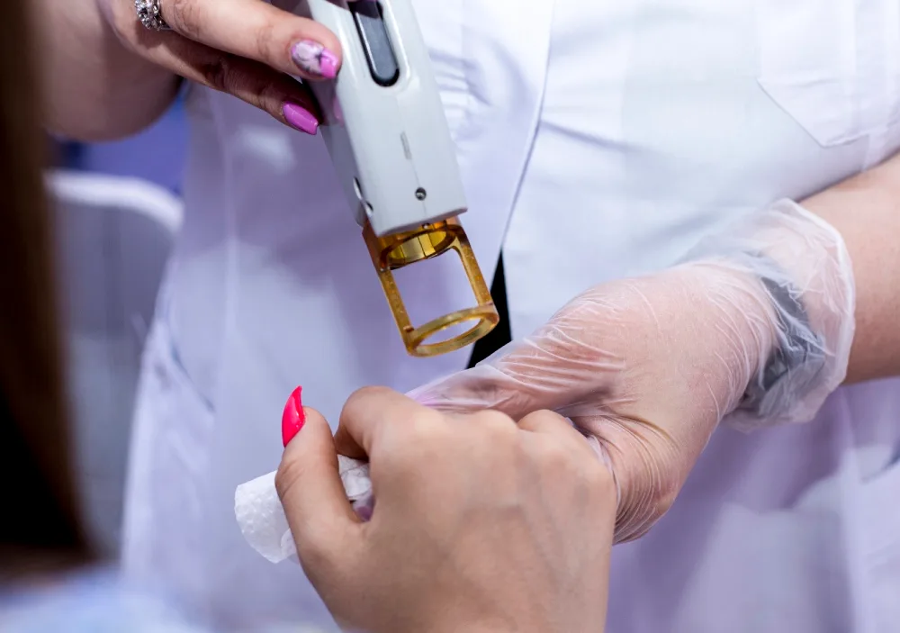 Q-Switched Laser treatment on hand Q-Switched Laser treatment on hand