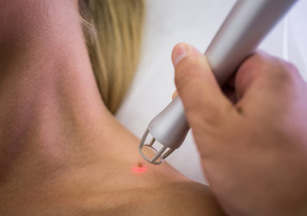 Dermatologist removing mole from woman's shoulder