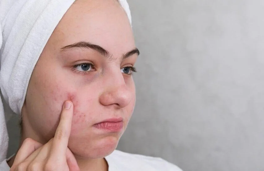 Acne Scar Treatment for Clear Skin & Pimple Mark Removal