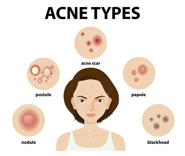 Types of acne scars