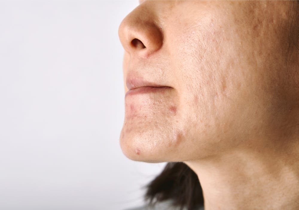 Acne Scars