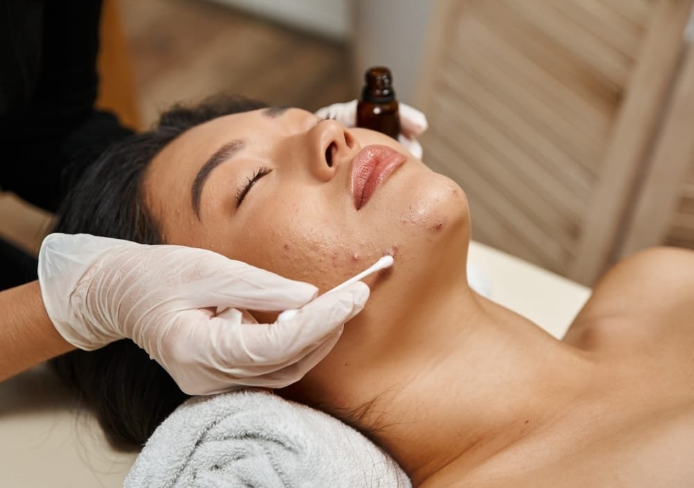 Can Acne Scars Be Prevented?