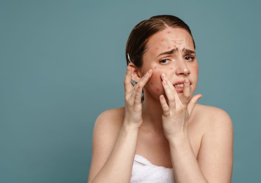Understanding What Causes Acne Scars
