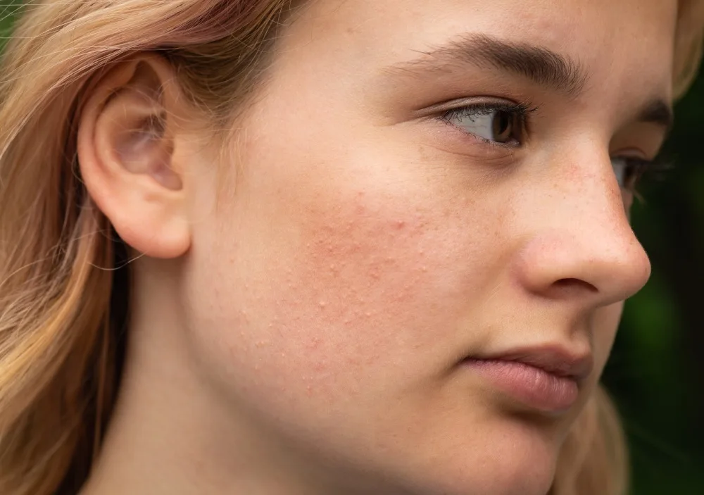 Who Can Benefit from Skin Brightening Treatments? Who Can Benefit from Skin Brightening Treatments?