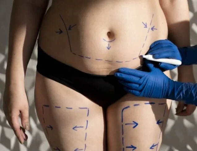 Areas That Can Benefit from Radiofrequency Skin Tightening