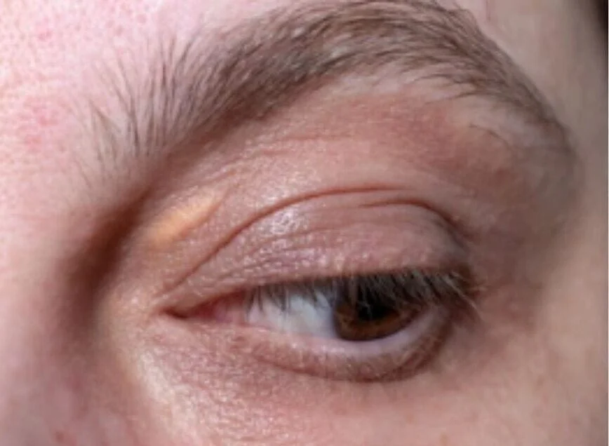 Xanthelasma: Symptoms, Risk Factors, and Prevention