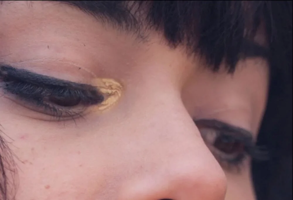 Xanthelasma Causes and Treatment