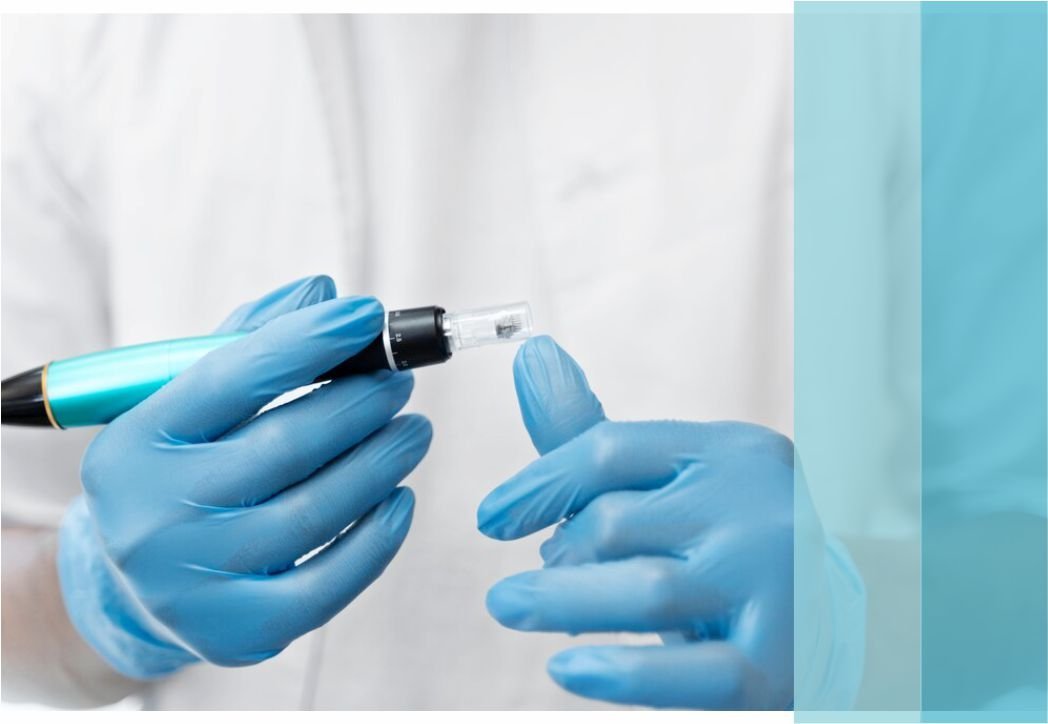 Areas of Microneedling Treatment