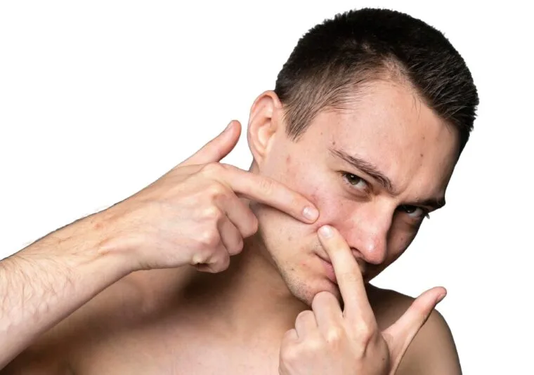 Clear Skin Ahead: Anti-Acne Peels for Radiant Results!