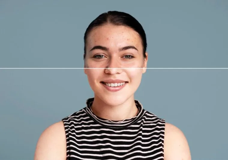 From Blemished to Beautiful: Anti-Acne Peels that Work!