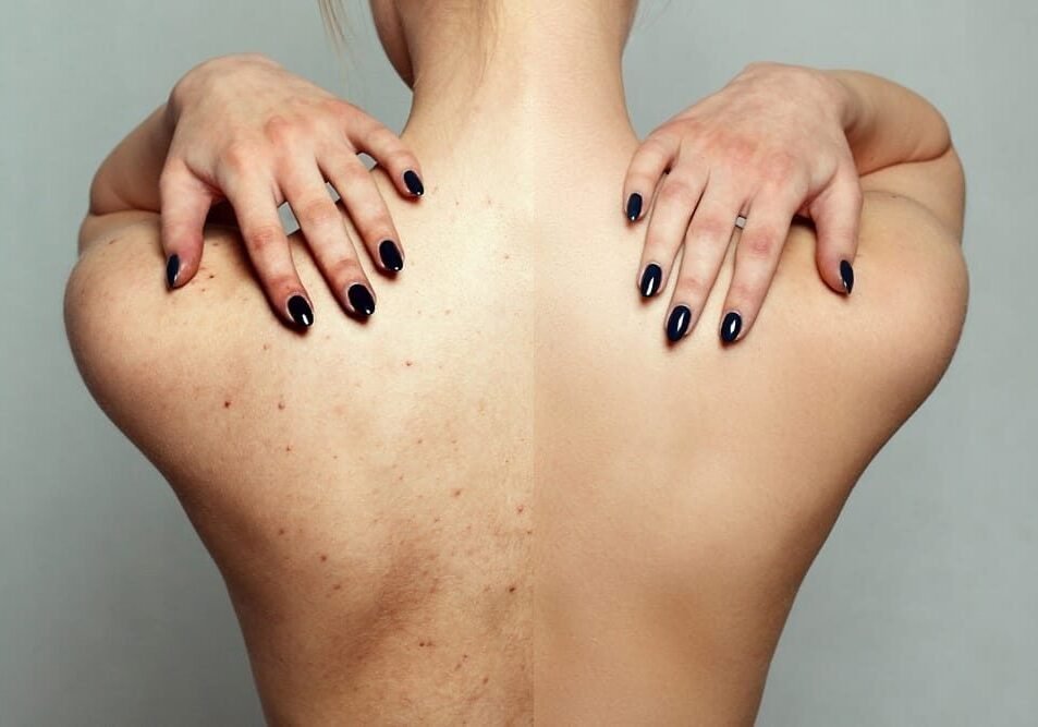 Before & after body hidden acne