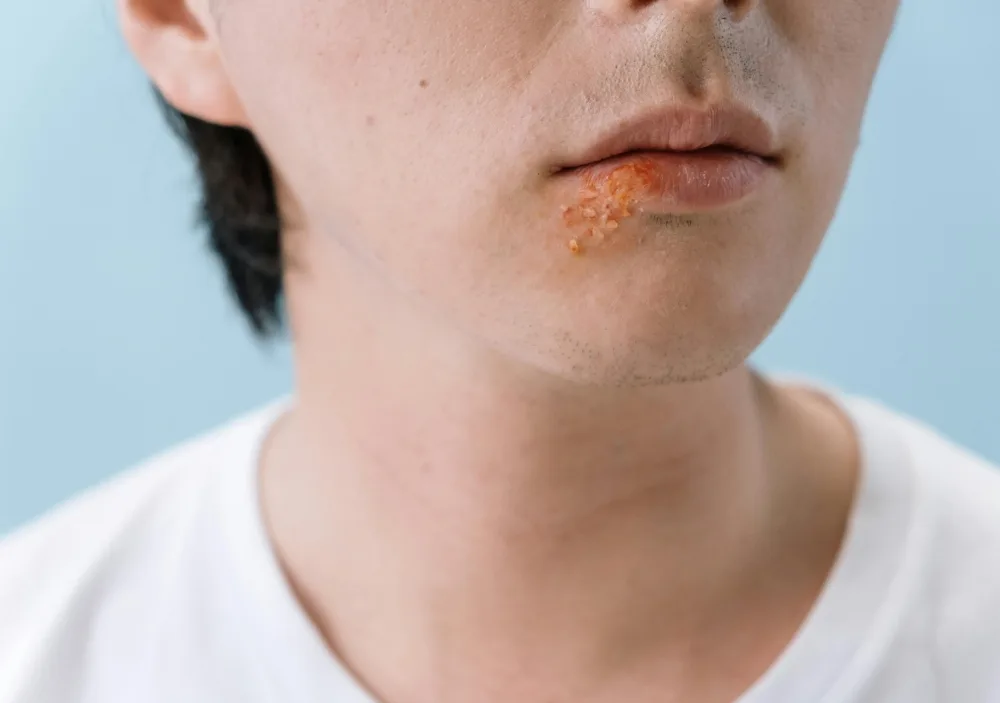 Managing Cold Sores: Treatment Tips