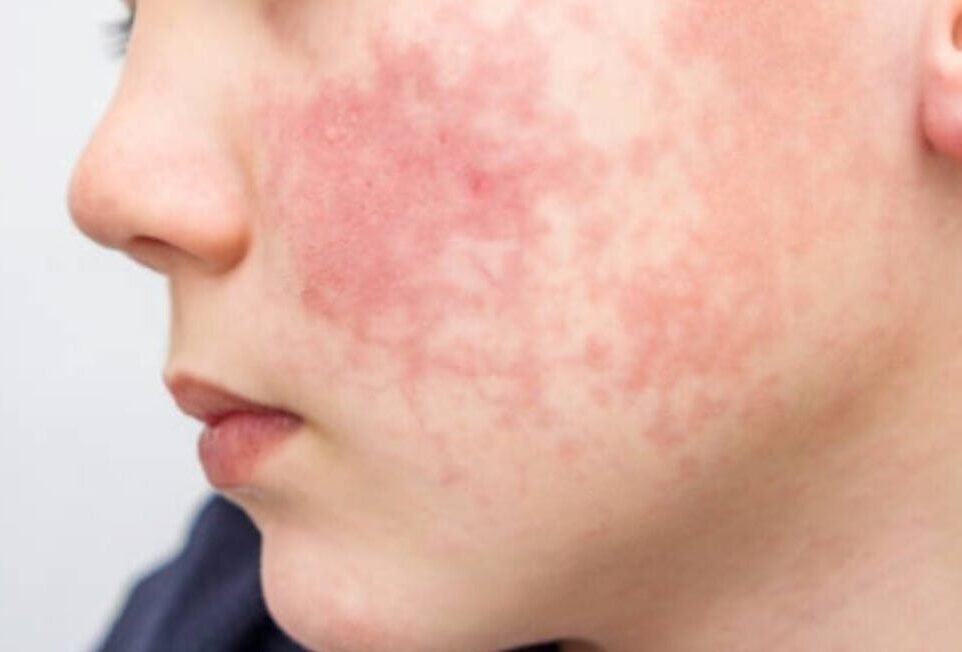 Eczema / Atopic Dermatitis