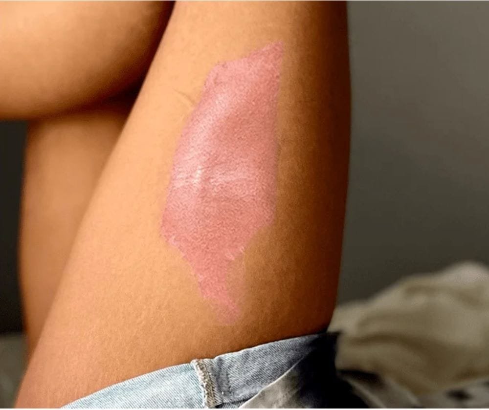 Eczema / Atopic Dermatitis