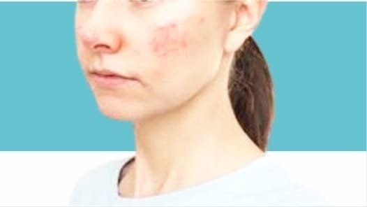 Eczema / Atopic Dermatitis