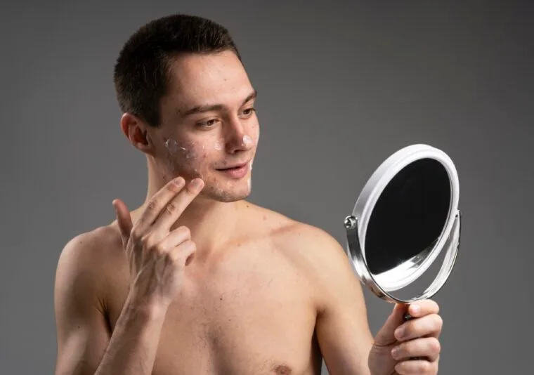 Facial Acne- Scarring That Could Haunt You Forever!