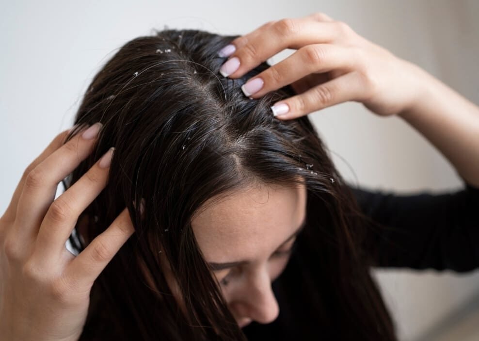Stop Hair Loss by improving Scalp Health with Scalp Peel