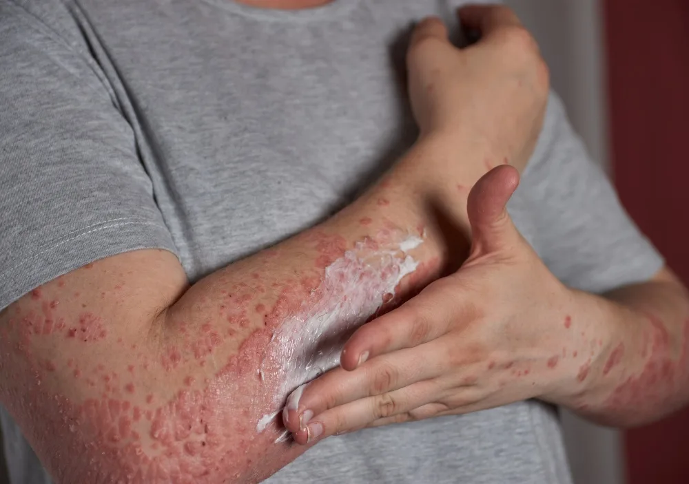Stop the Itch: Proven Treatments for Hives