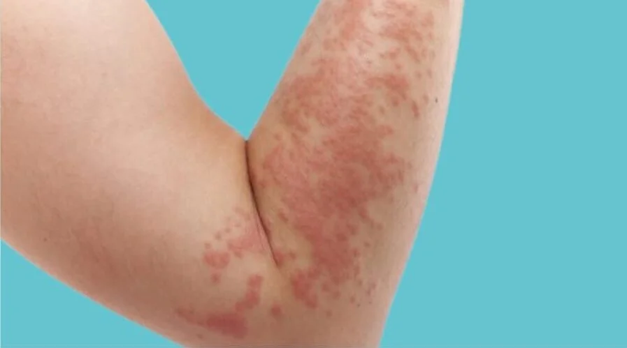 Symptoms and Treatment for Hives