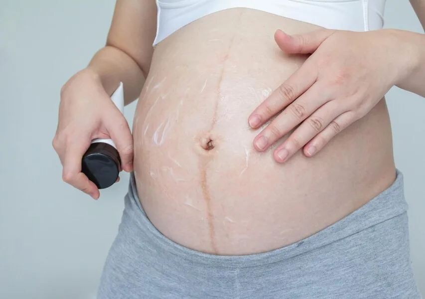 Transform Stretch Marks Into Smooth, Radiant Skin!