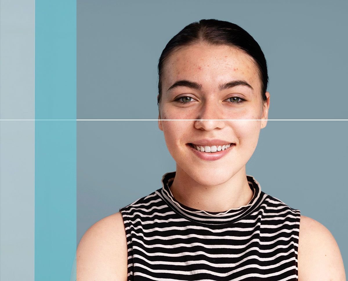 Fairness & Pigmentation