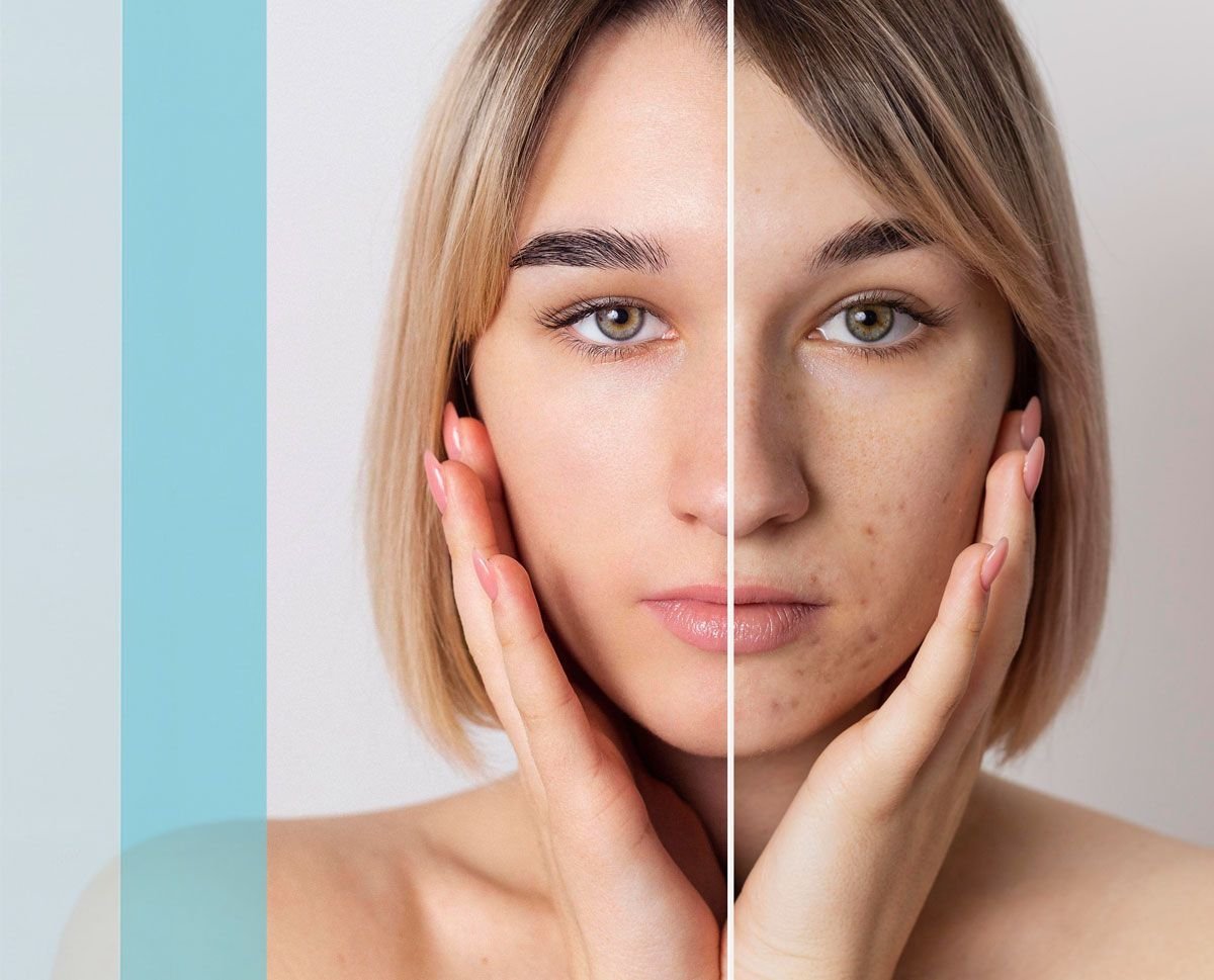 Fairness & Pigmentation