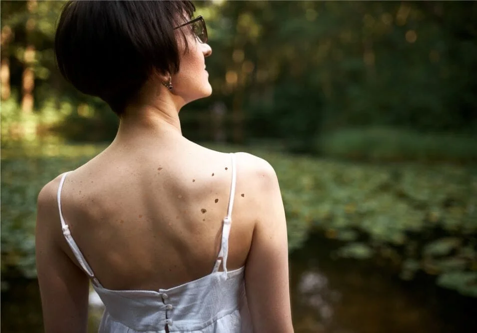 Skin Tags Unveiled: What They Are and Why They Happen