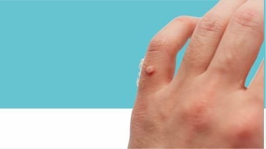 Skin Warts