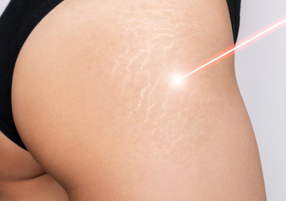 Effective Stretchmark Reduction Treatment for Smoother Skin