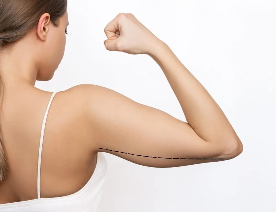 Minimally Invasive Thread Lift for Body Sculpting