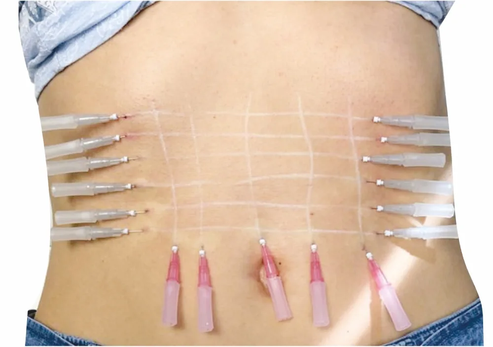 Non-Invasive Threadlift: Radio Frequency for Body Contouring