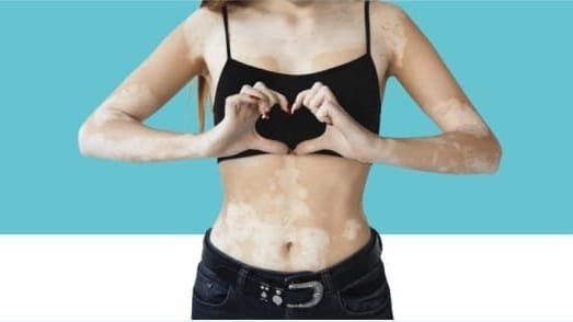 vitiligo
