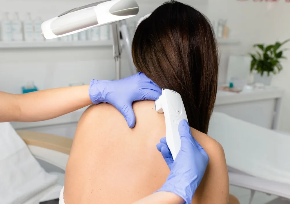 Q-Switch Laser Treatment