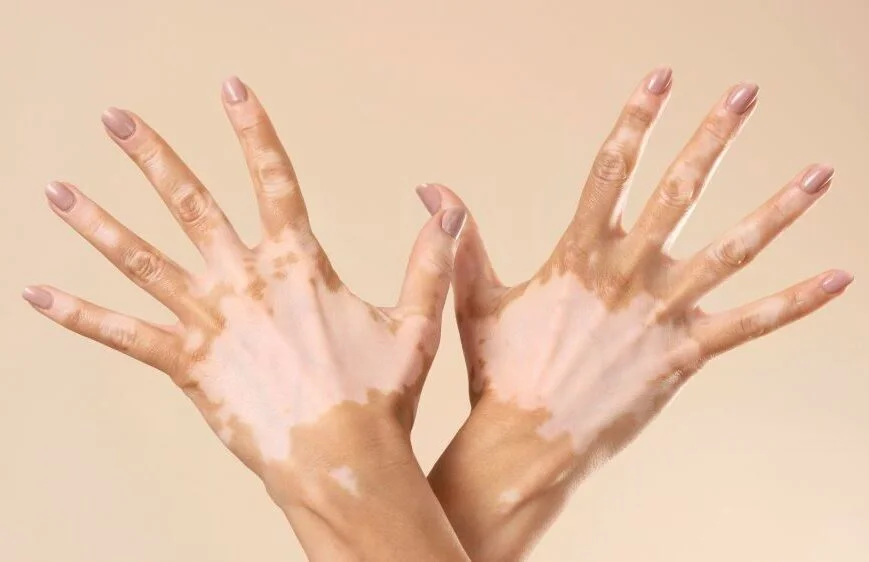 Vitiligo Treatment Can Restore Skin Colour, but Recurrence Is Possible