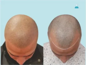 Scalp Micro Pigmentation