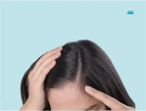 Scalp peel