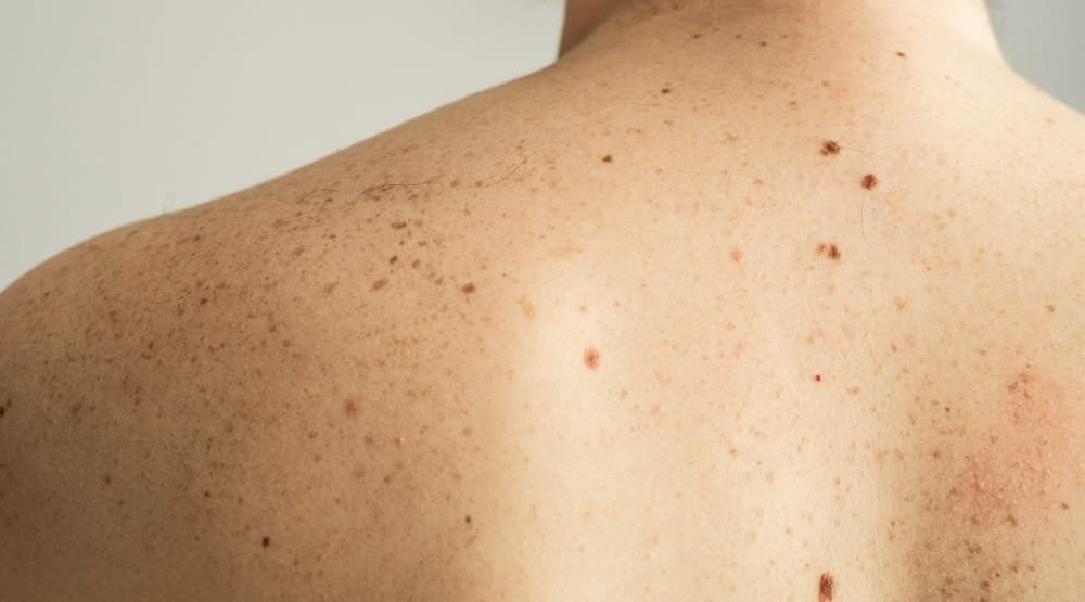 Body Acne & Scars