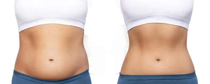 4. Does CoolSculpting work for Abdomen?