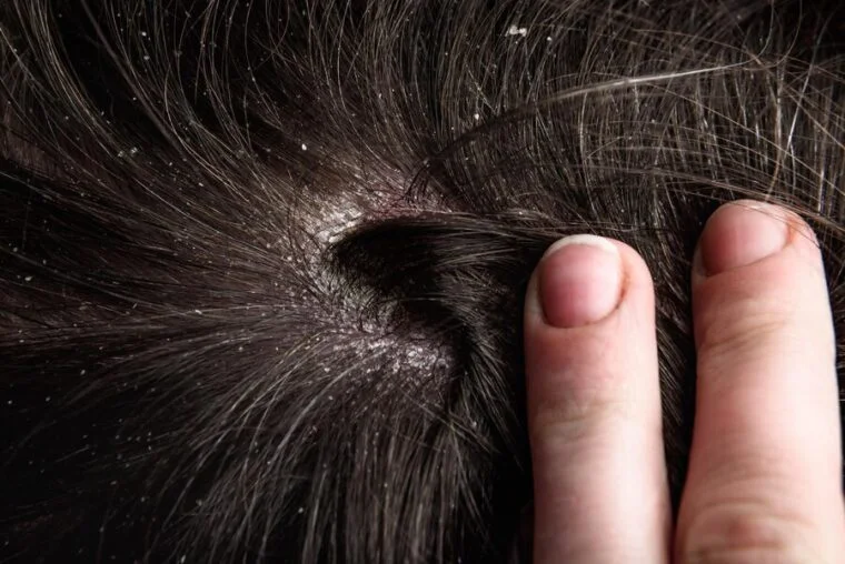 The Importance of Scalp Health