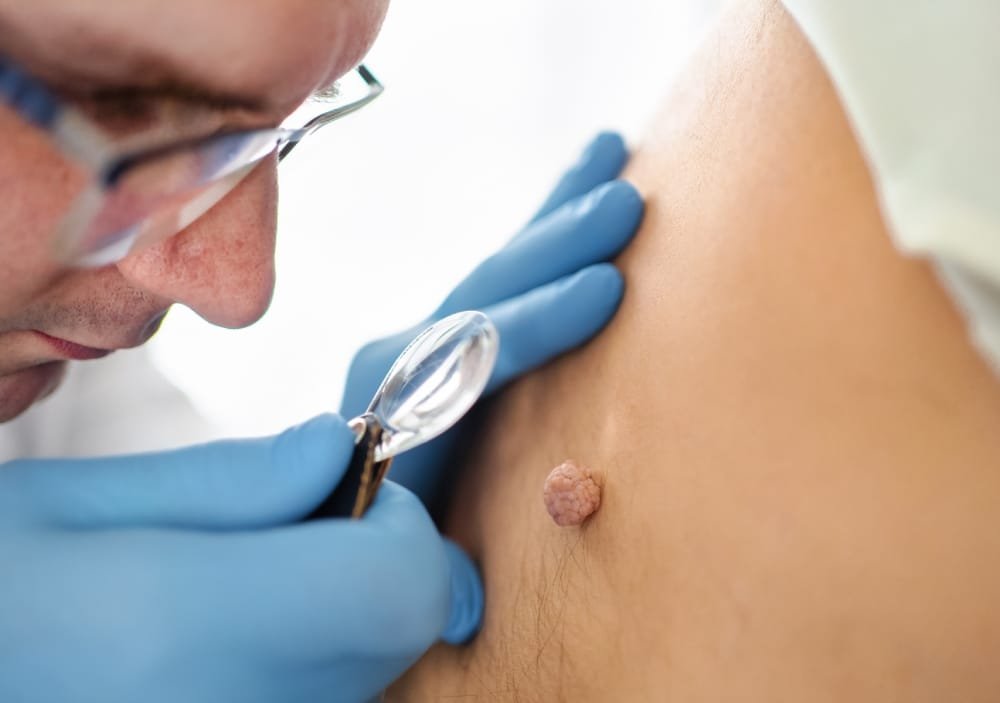 What Are Warts? What Are Warts?