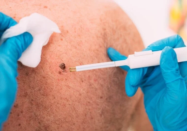 How to Remove Warts Permanently