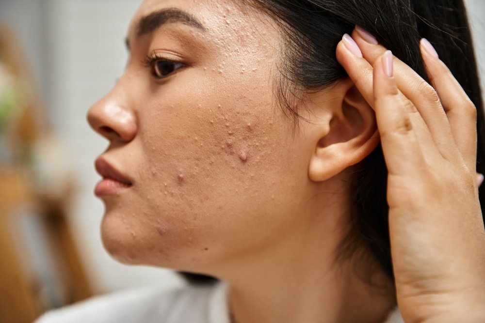 Acne Scar Treatment for Clear Skin