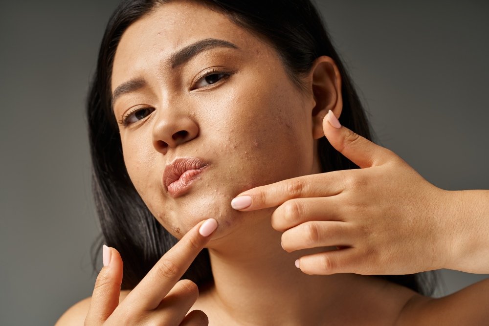 The Emotional Impact of Acne Scars
